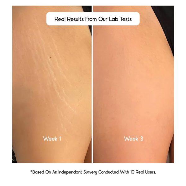 Cos-IQ Stretch Marks Removal Roll-On Serum with Striover - Image 2